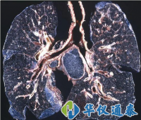 你知道什么是塵肺病嗎？使用粉塵儀可以降低塵肺病的發生率